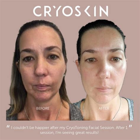 Cryoskin facial - Cryotherapy facials use a blast of extremely cold air to treat a variety of skin conditions on the face and neck. These facials are said to help reduce inflammation and promote collagen production, although there is little scientific evidence to support this. Possible side effects include hyperpigmentation and a very small risk of frostbite.